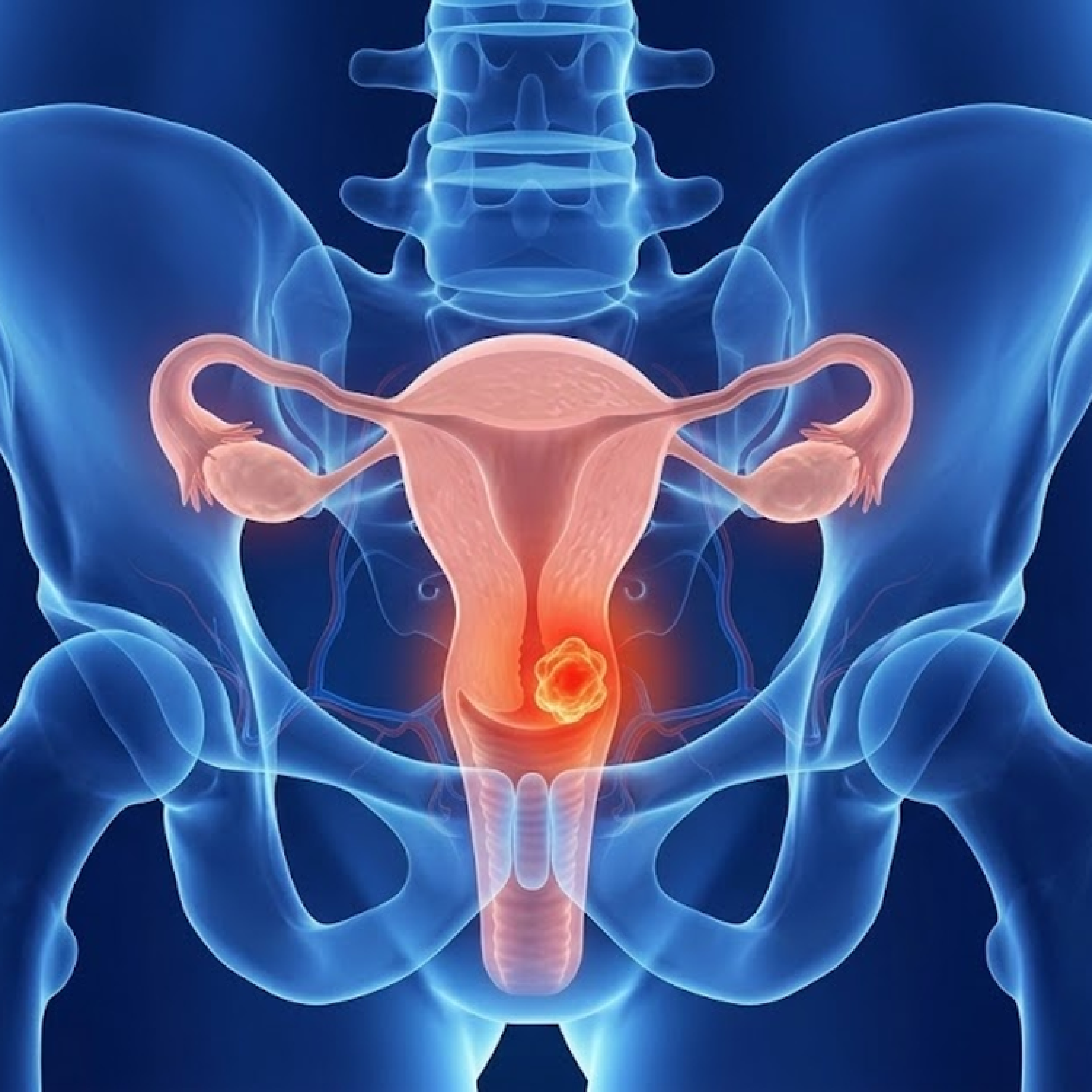 cervical cancer (1)