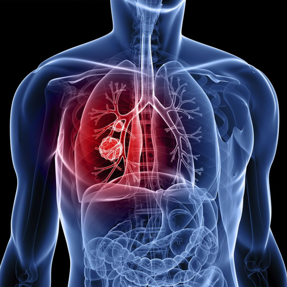 lung cancer